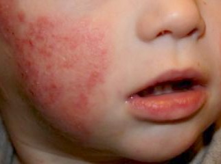 El bálsamo el socorrista de atopicheskogo de la dermatitis