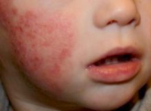 Tratamiento para la dermatitis atópica
